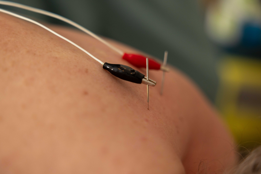 Akupunktur Din Kropp Din Helse 3